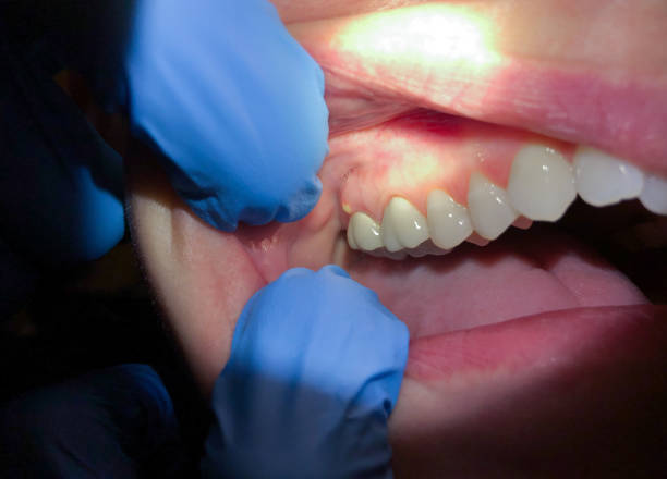 Best Emergency Dental Care for Broken or Chipped Teeth in Lead, SD